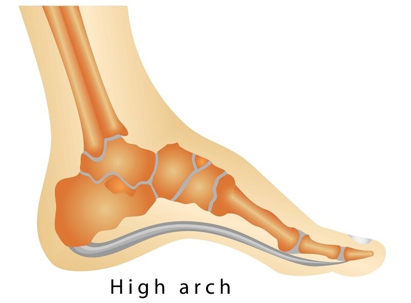 تشخیص و درمان گودی و قوس زیاد پا