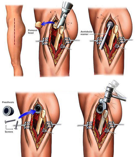 جراحی پروتز لگن