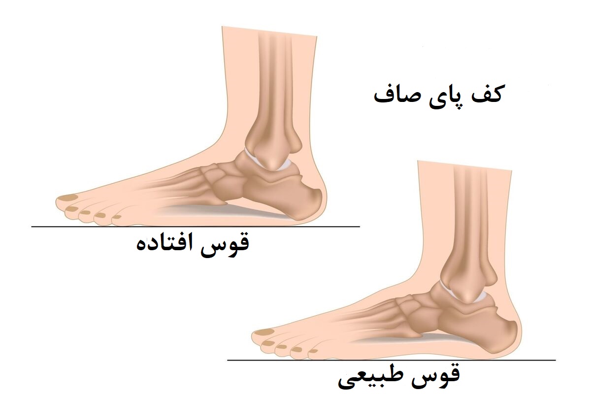 درمان کف پای صاف در کودکان