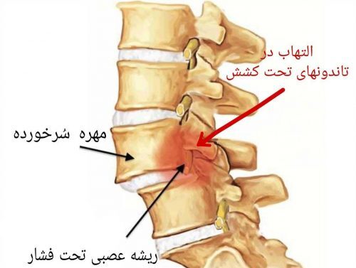 زمان بستن کمربند شکستگی کمر